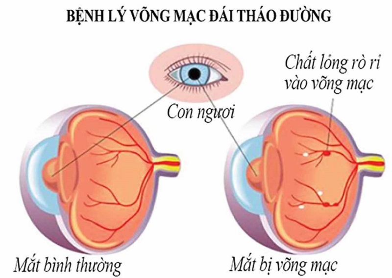 Bệnh võng mạc đái tháo đường không tăng sinh là do tổn hại các tế bào quanh mao mạch võng mạc